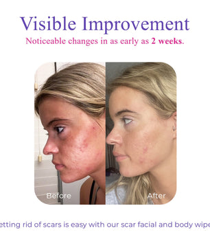 Derminish® Scar Wipes