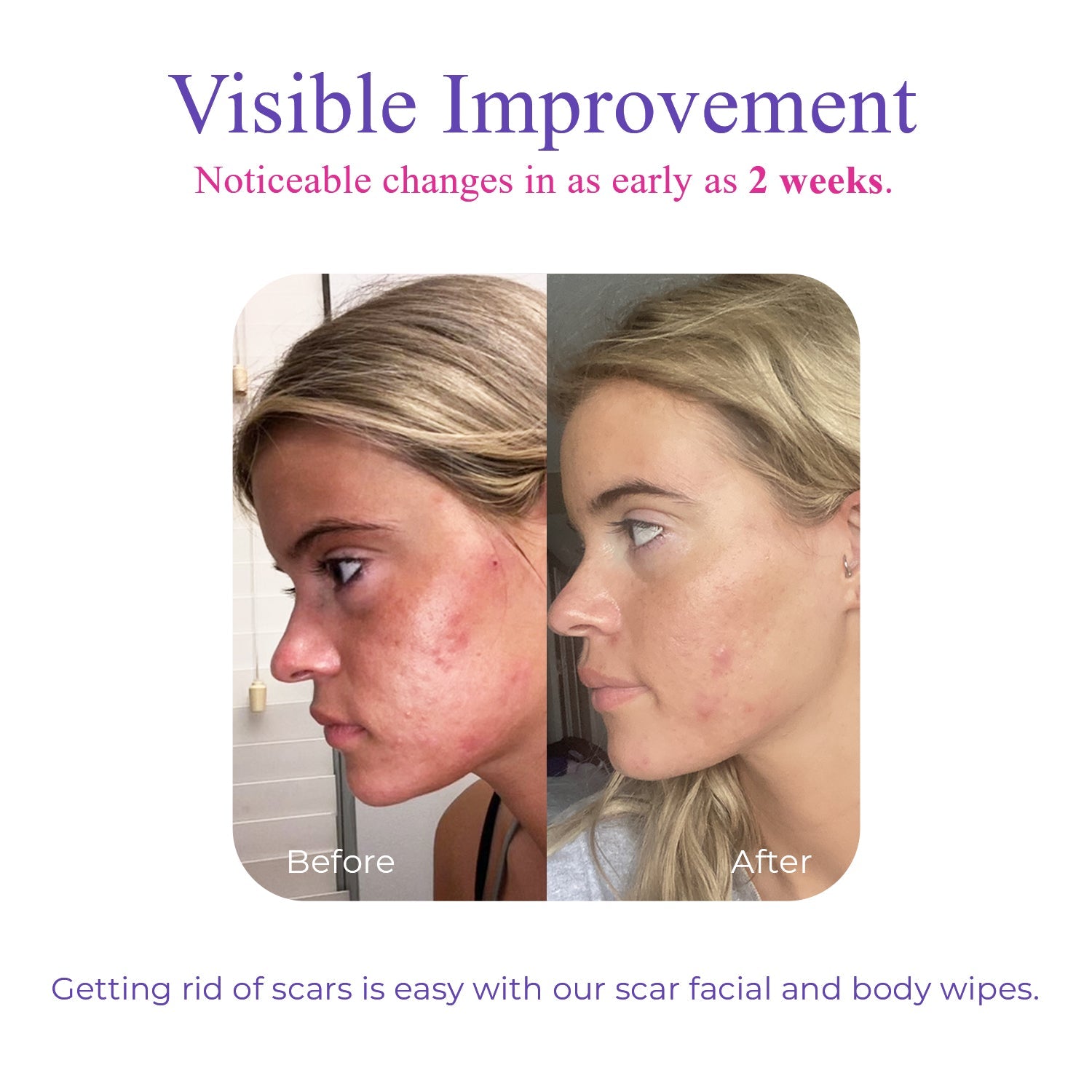 Derminish® Scar Wipes
