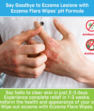 Eczema Flare Wipes®